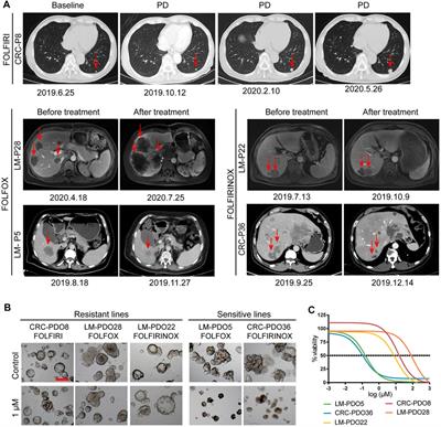 Patient-derived organoids as a platform for drug screening in metastatic colorectal cancer